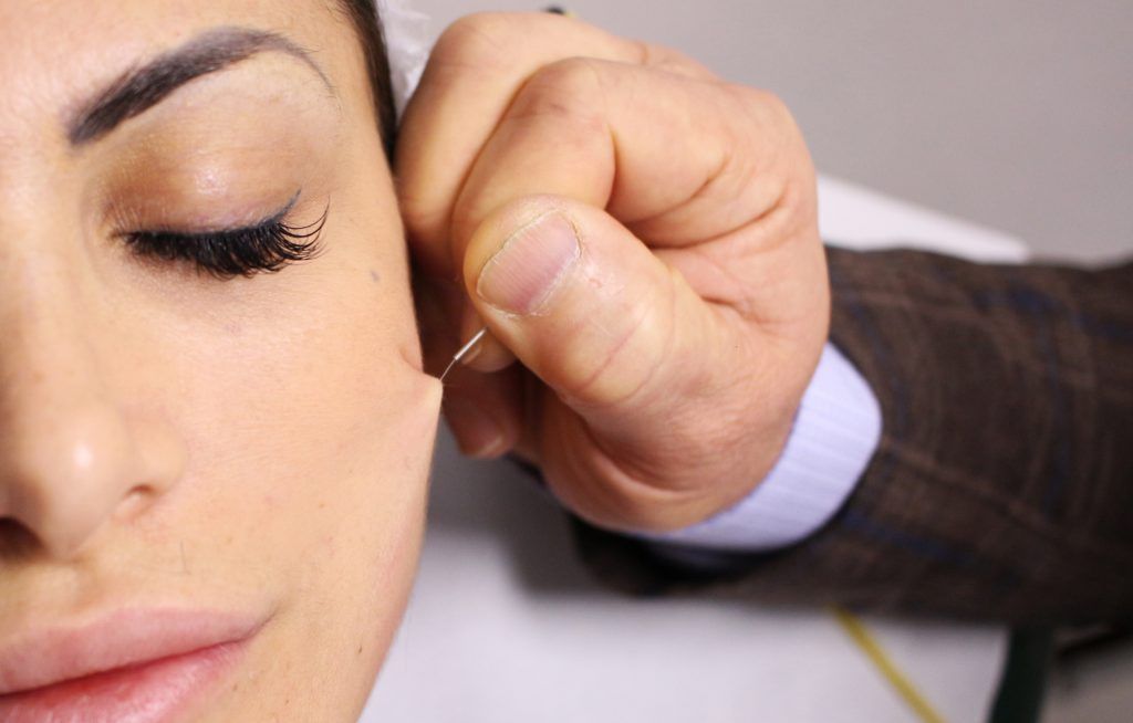 The latest facelift trend is based on acupuncture
