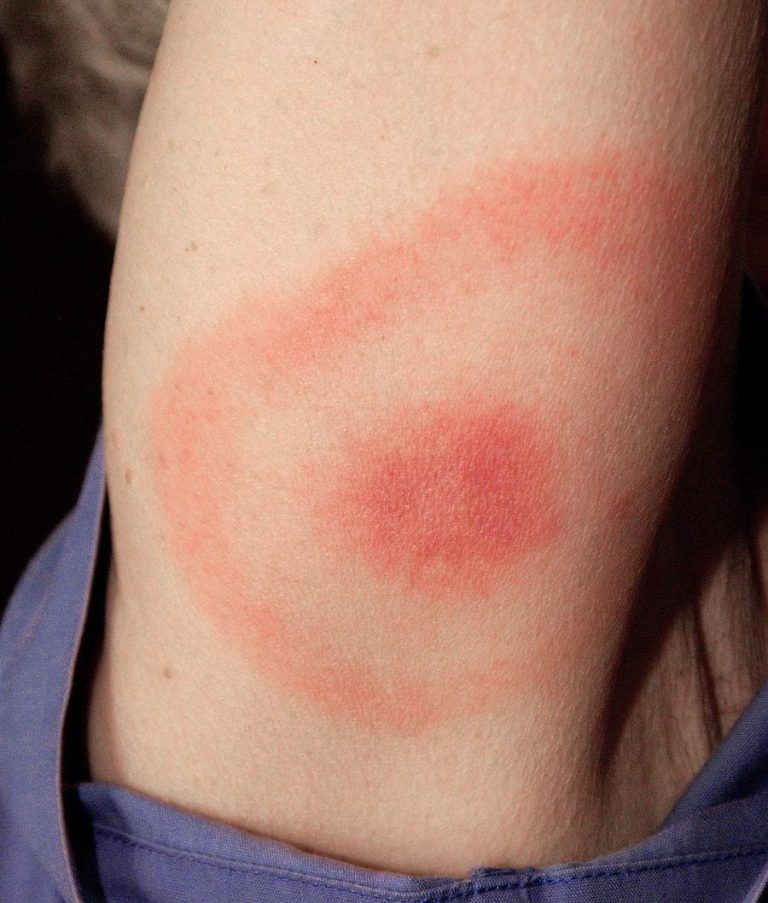 Lyme Disease: Celebrities Who Have It And Their Long Battle Against It